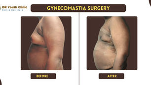 Get rid of enlarged breasts