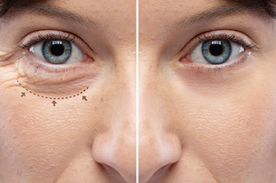 Blepharoplasty or Eyelid Surgery
