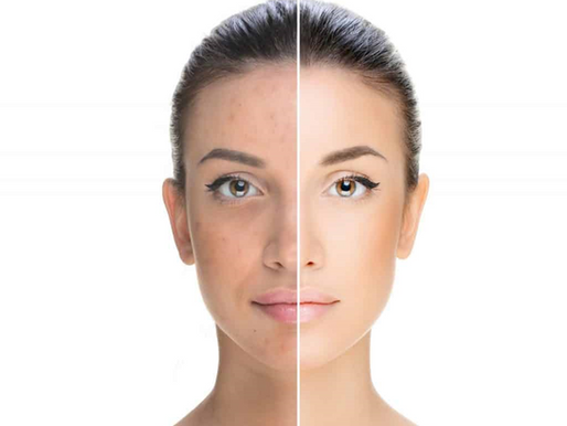 Unveiling Radiance: Dr Youth Clinic's Pre-Wedding Tan Removal Treatment in Chennai Anna Nagar East