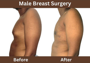Male Breast Reduction SurgerY