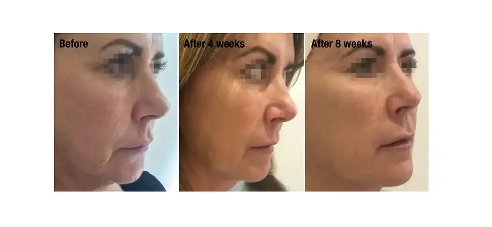 Profhilo Before After VBS 3