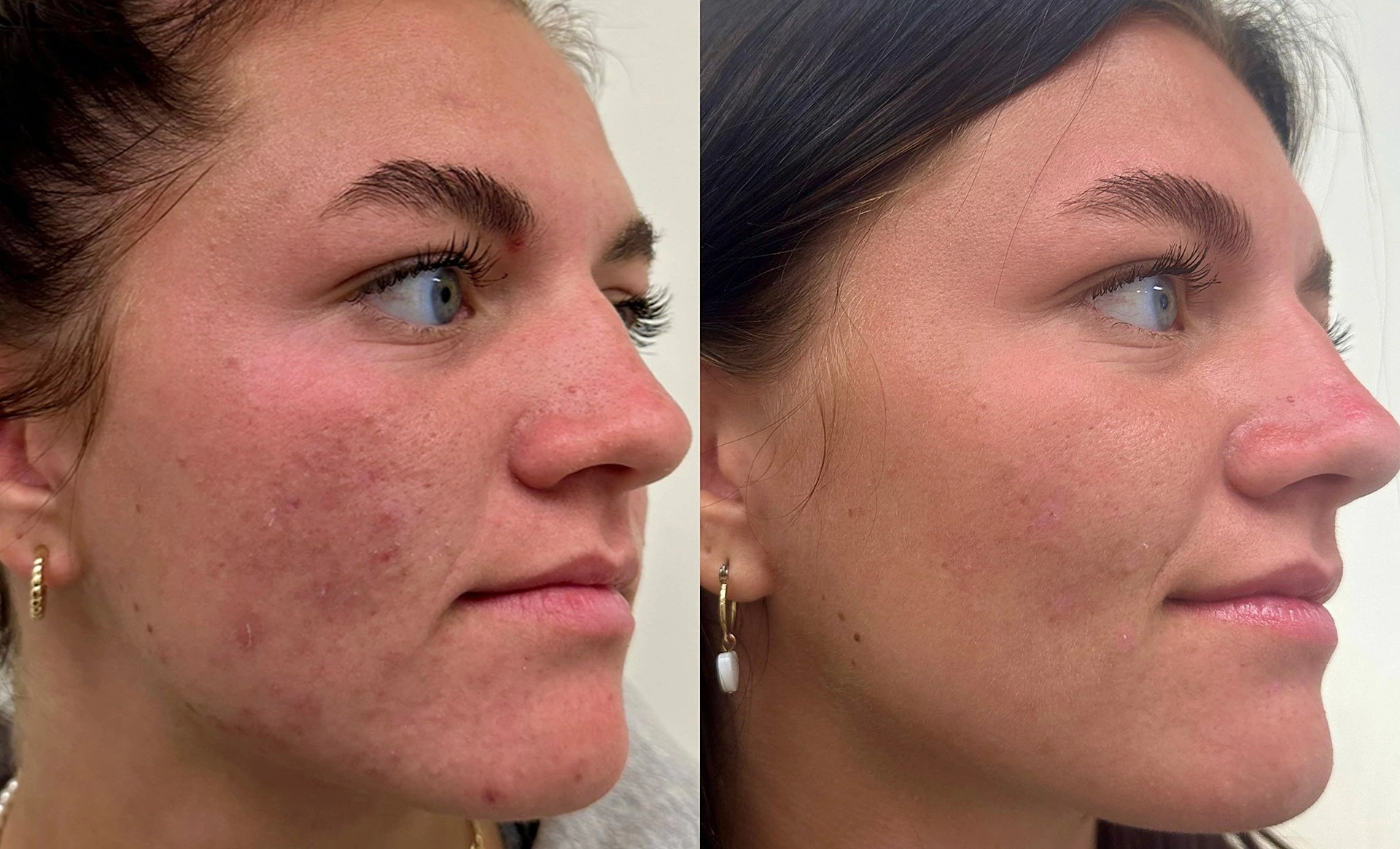 microneedling before after victoria london