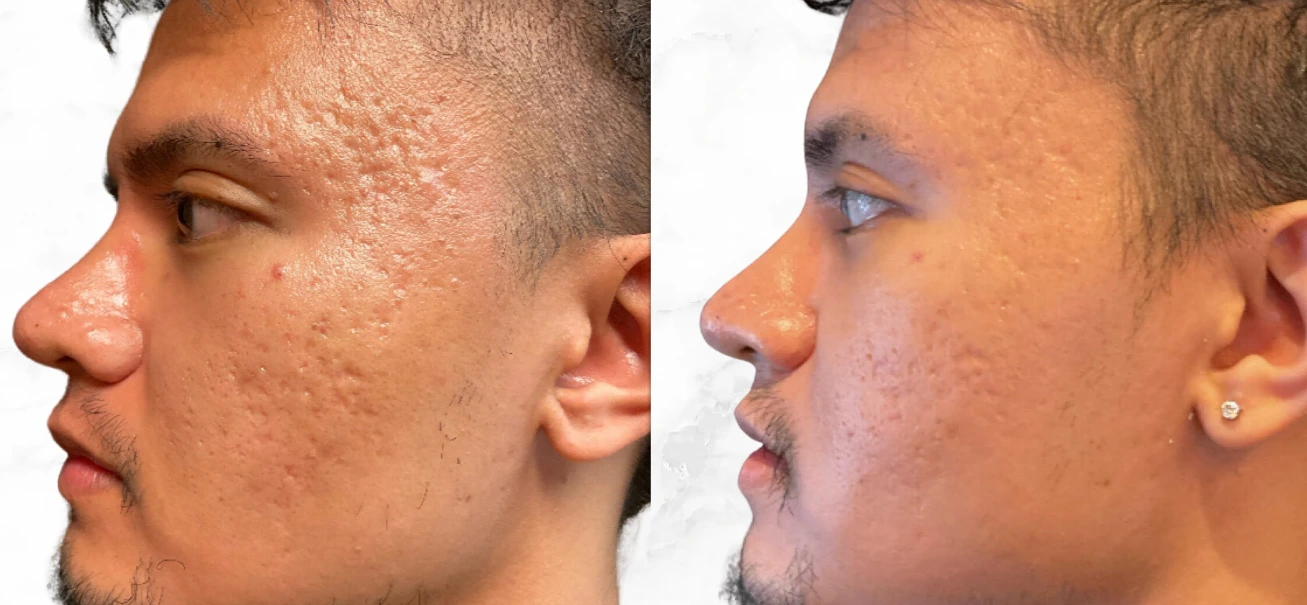 microneedling before after victoria london