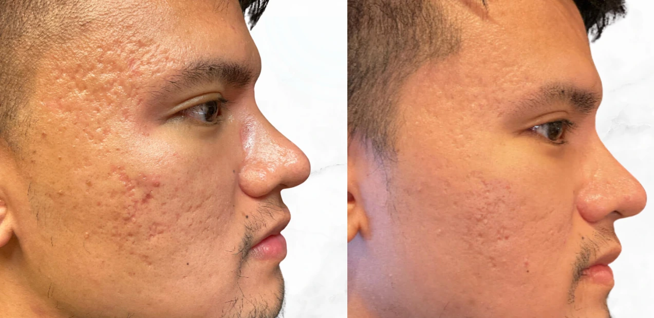 microneedling before after victoria london