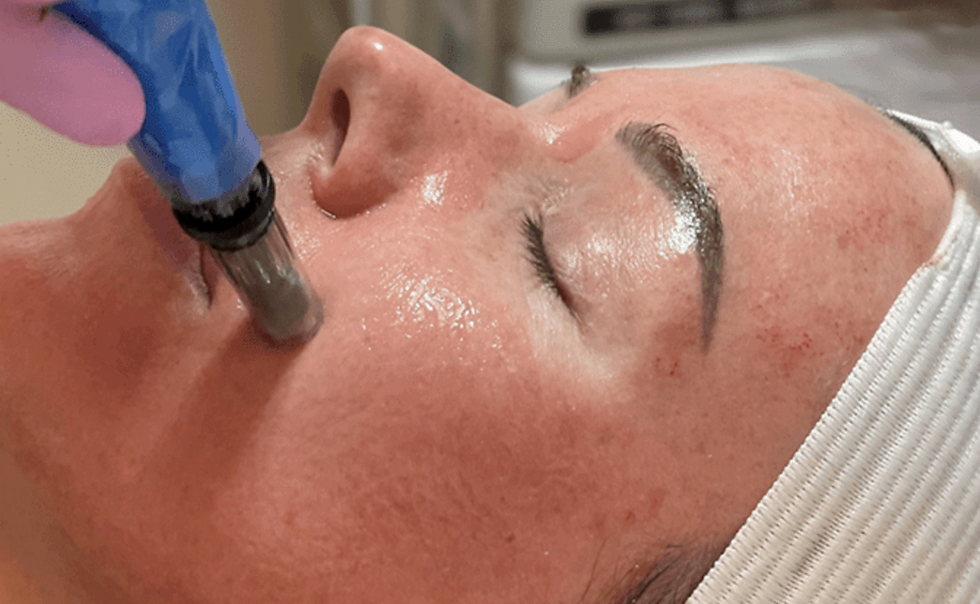 microneedling image.jpeg