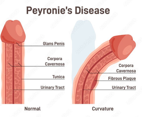 Will My Partner Feel the Curvature Caused by Peyronie's Disease During Sex?