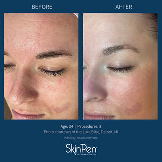 Microneedling treatment results – reduced redness and smoother skin after 2 sessions (female, age 34)