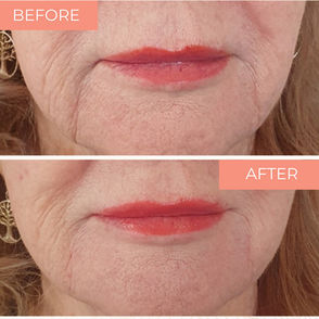 Dermal filler for marionette lines – skin rejuvenation at Luminous Skin Richmond