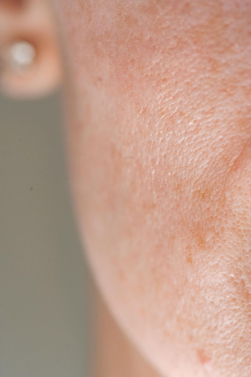 Photo of a client with large pores