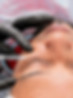 Male patient receiving under eye filler