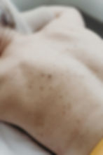 dark spots on patients back