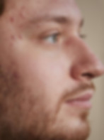 acne scars on man