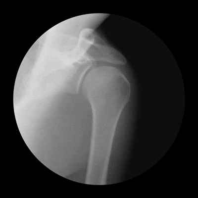frozenshoulder.gif