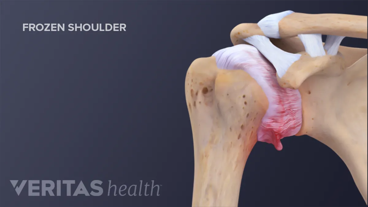 Adult-Shoulder-Joint-frozen-shoulder.webp