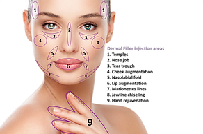 dermal filler for facial sculpting