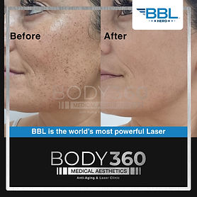 BBL Laser.jpg