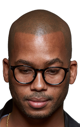 Hilton Hair Smp Hair Tattoo Head Tattoo Baldness Hair Loss