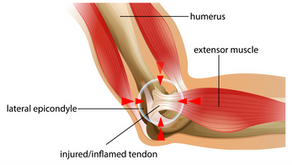 Understanding Tennis Elbow Pain Causes and Effective Treatment Strategies