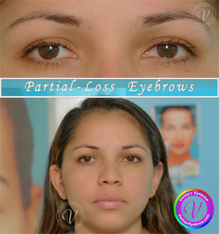 Bald Spot Brow Correction