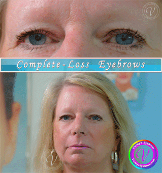 Microblading Alopecia Brow
