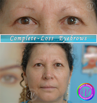 Full Loss Brow Microblading