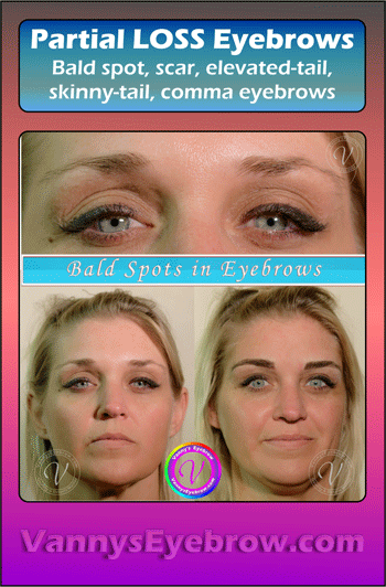 Bald Spot in Eyebrow Solution