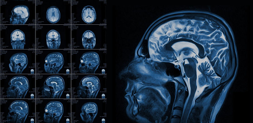 Using-Diagnostic-Imaging-to-Detect-Chronic-Traumatic-Encephalopathy-CTE-scaled_edited.jpg