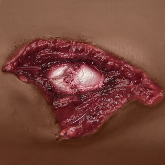 Thumbnail: Compound Fracture - Humerus - Dark