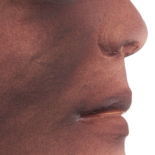 Thumbnail: Burn - Face - 2nd/3rd Degree