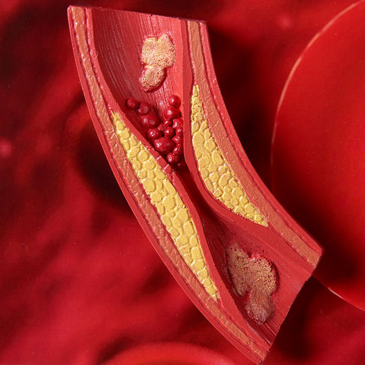Thumbnail: The Consequences of Diabetes 3-D Display - 28 in. x 27 in.