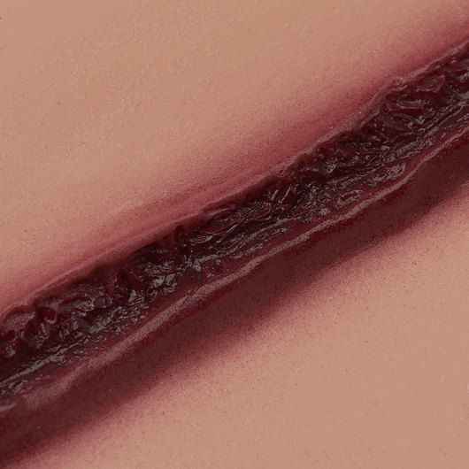 Thumbnail: Lacerated Forearm