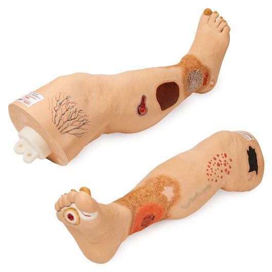 "Vinnie" Venous Insufficiency Leg