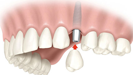 Implantes dentales