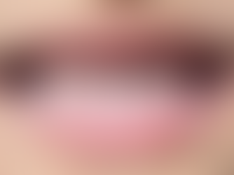What Are Orofacial Myofunctional Disorders (OMDs)?