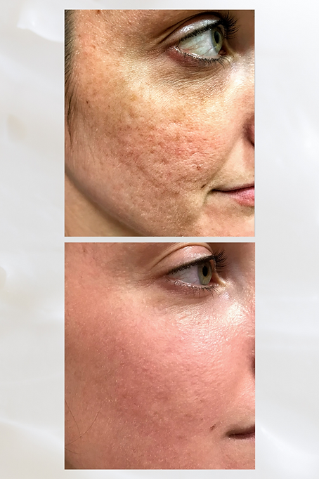 HALO Laser by Sciton at Vybrance Medaesthetics