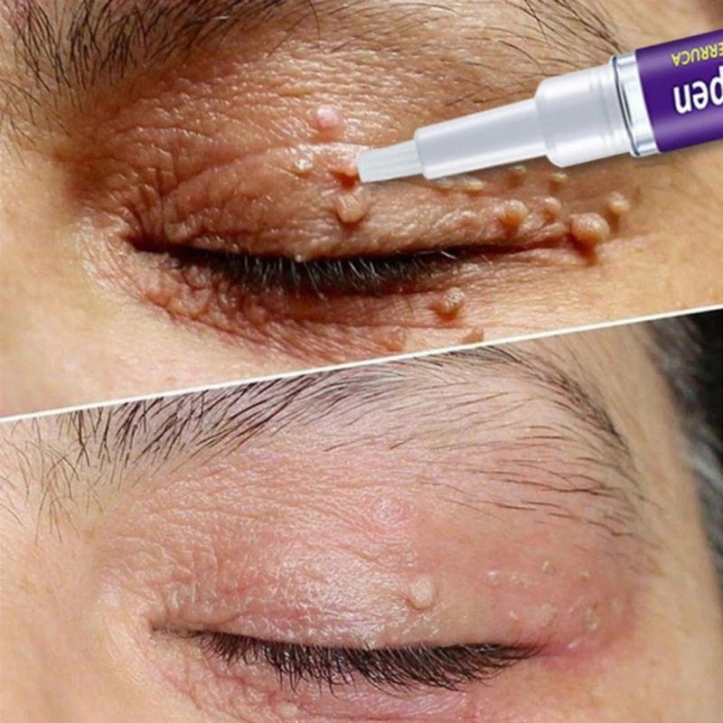 Thumbnail: Removing Against Moles Remover Anti Verruca Remedy Liquid Pen Treatment Papillom