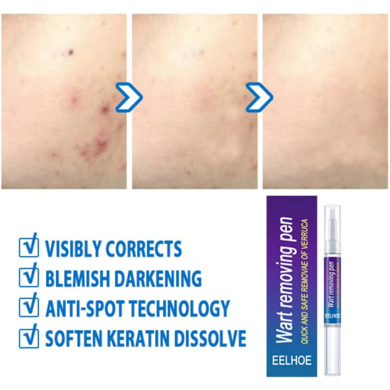 Thumbnail: Removing Against Moles Remover Anti Verruca Remedy Liquid Pen Treatment Papillom