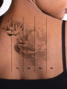 tattoo-removal.jpg