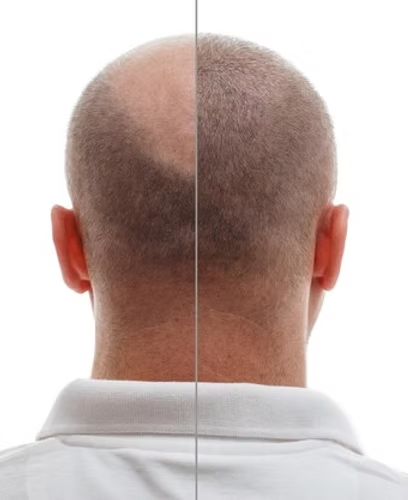 SCALP PIGMENTATION: The Breakthrough Solution for Thinning Hair and Baldness at The Brow Clinic Texas