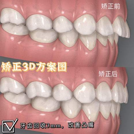 英国隐适美矫正案例10
