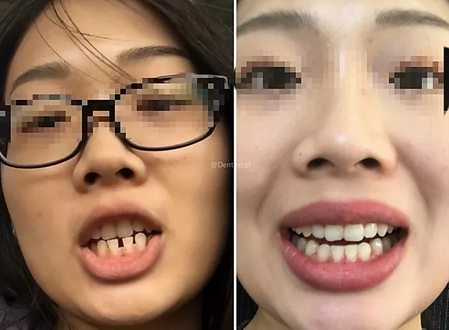 隐适美英国整牙经验帖 三个月神级矫正