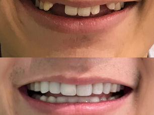 隐适美牙齿矫正后种植牙,拯救‘天生缺牙’