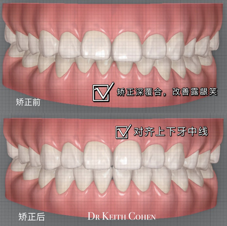 英国隐适美矫正案例10