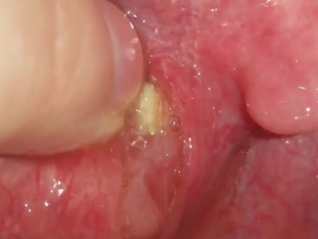 Ever heard of tonsil stones?