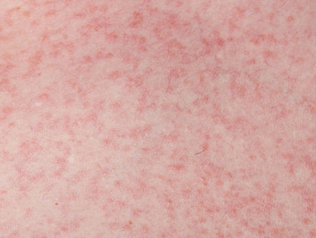 Dengue rashes: Appearance, Symptoms and Meaning