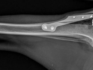 TTA - operace kolene po ruptuře předního zkříženého vazu