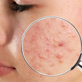 comment soulager l'acné inflammatoire nos solutions naturelles, terra di natura