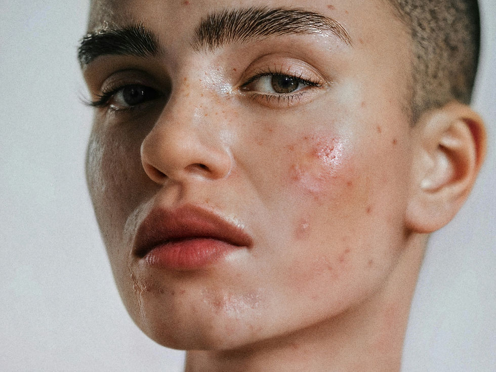 Visage de femme souffrant d'acné sévère
