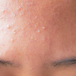 traitements et solutions naturelles pour en finir avec les boutons d'acné