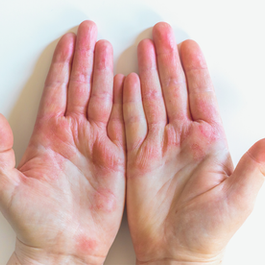 soigner l'eczéma sans cortisone : traitements doux et apaisants, terra di natura